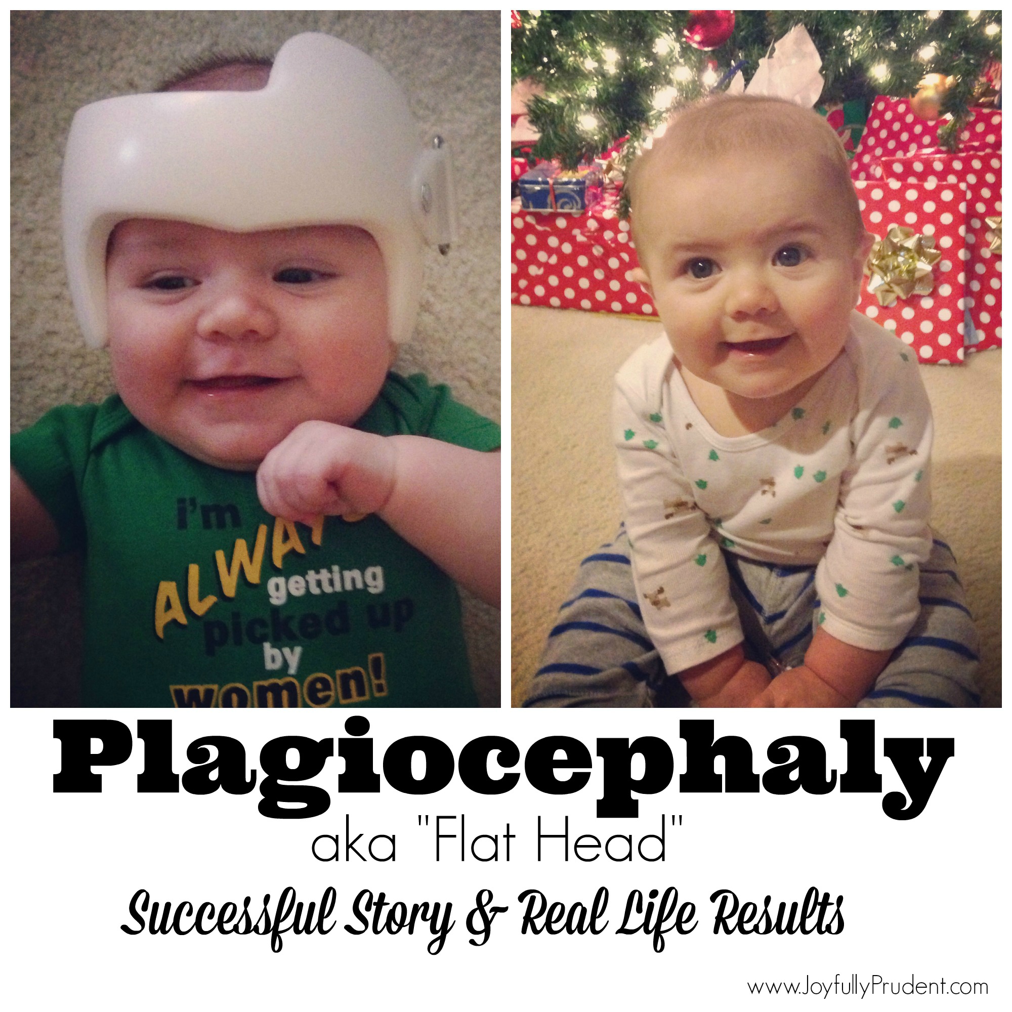 Plagiocephaly My Son S Experience Joyfully Prudent