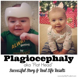 Plagiocephaly: My Son’s Experience